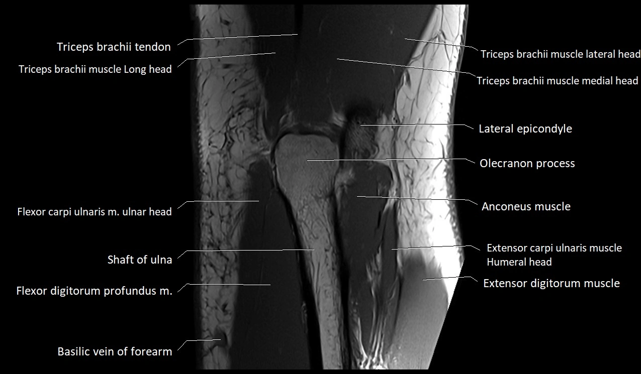 Elbow coronal anatomy image  cross sectional 3T MRI image 26.webp